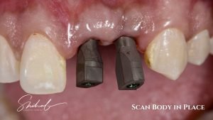 Best dental implant surgery in bangladesh