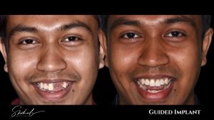 Before and after image of dental implant surgery at LASER DENTAL