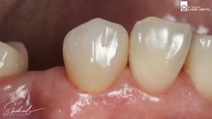 Ceramic teeth crown_tooth crown_best dentist_celebrity dentist