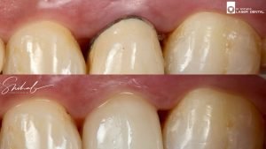 Before and after photo of teeth crown