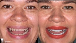 Before After Image Comparison for Emax Veneers_Porcelain Veneers