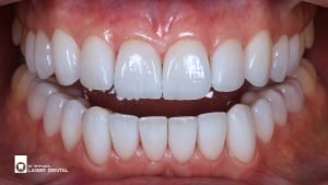 Celebrity-Worthy Hollywood Smile Makeover with Porcelain Veneers – LASER DENTAL, Uttara