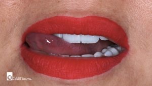 Same-Day Zirconia Crowns for a Radiant Smile – LASER DENTAL, Uttara’s Top Cosmetic Dentist