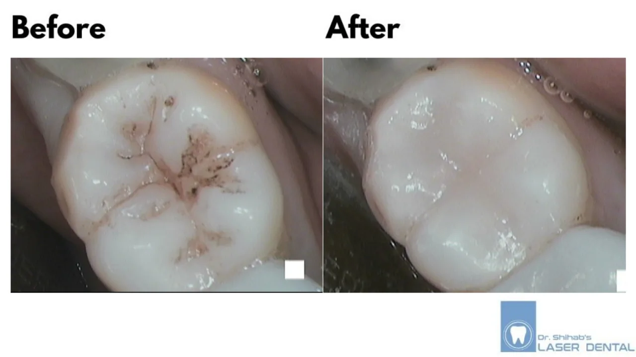 DENTAL FILLING