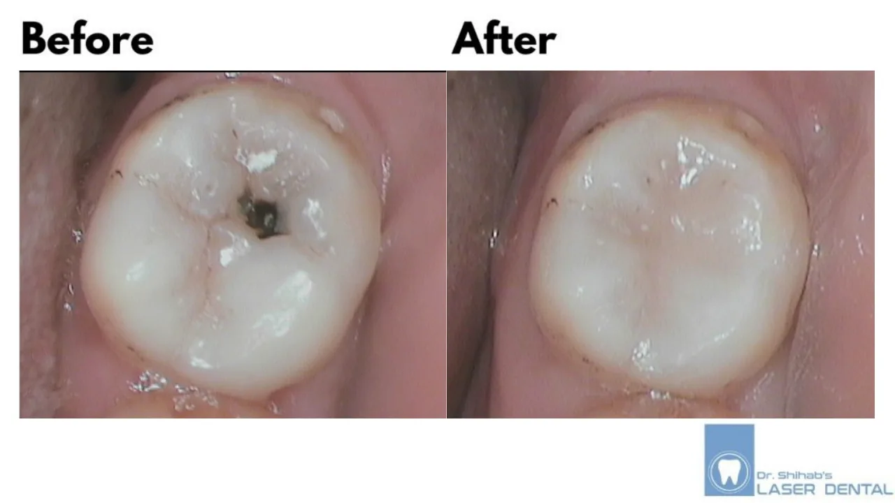 DENTAL FILLING