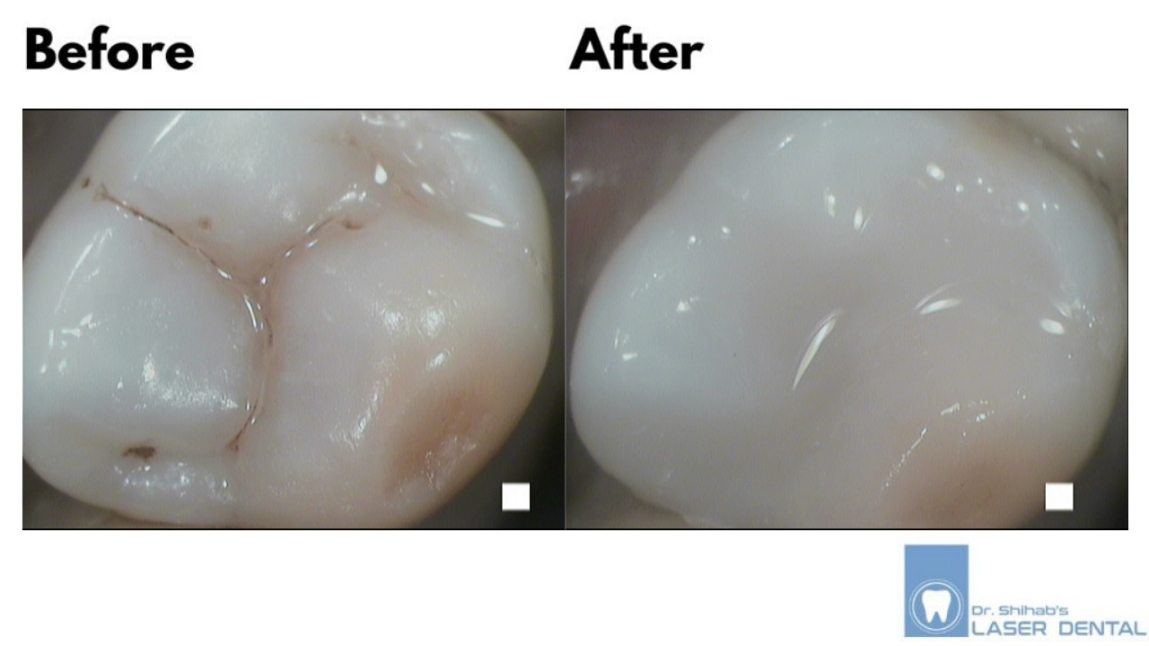 DENTAL FILLING