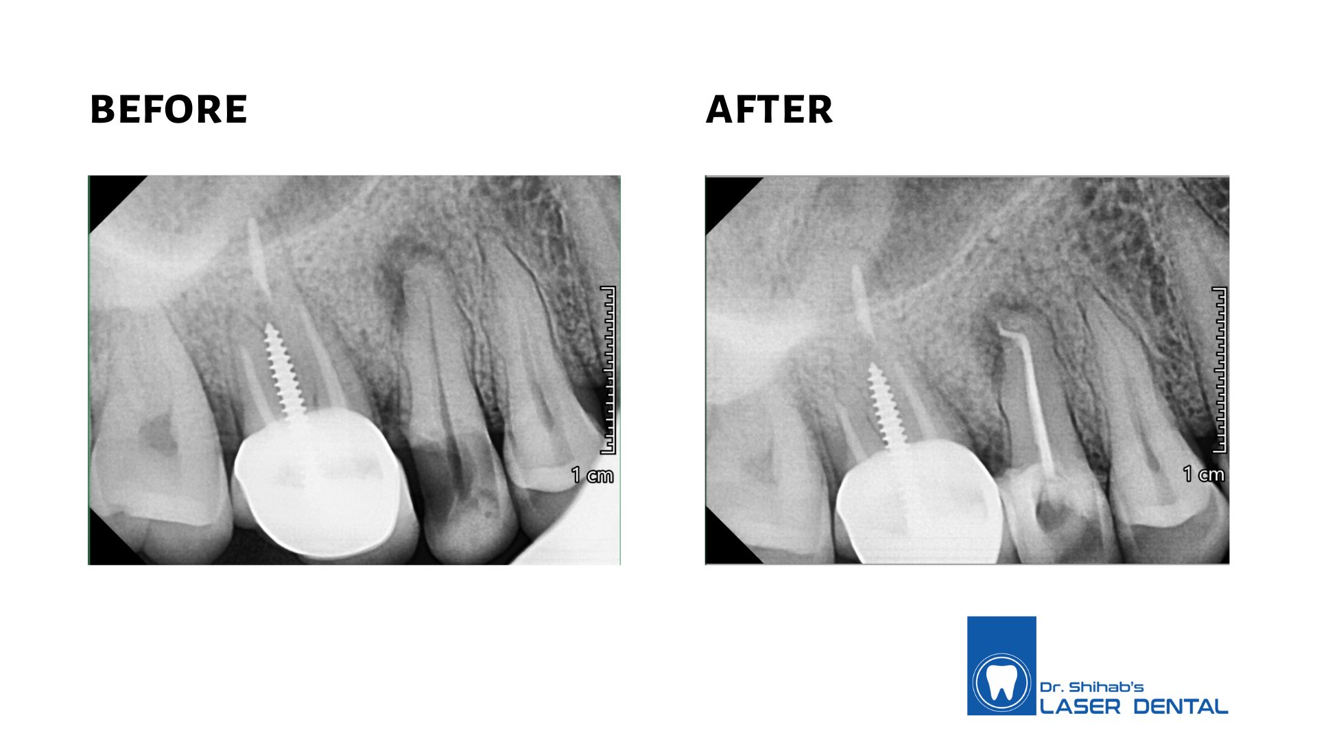 Root canal treatment