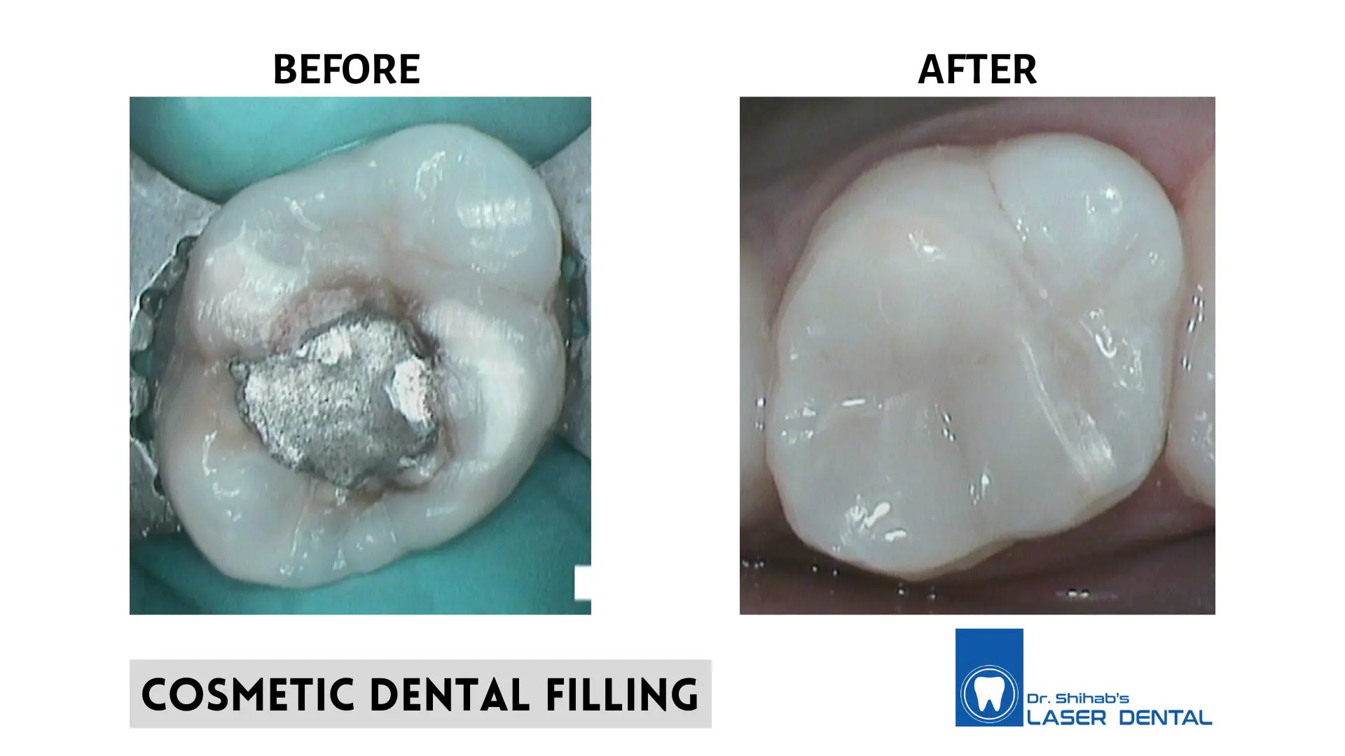 Cavity Filling Before And After