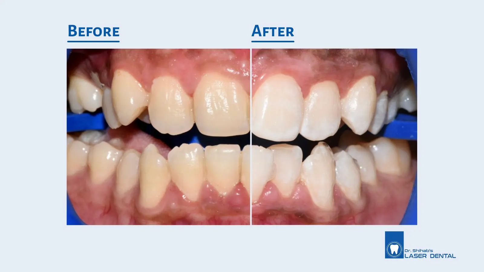 Teeth Whitening