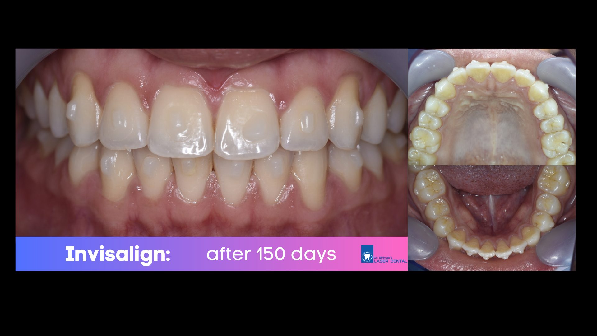 Invisalign clear aligner