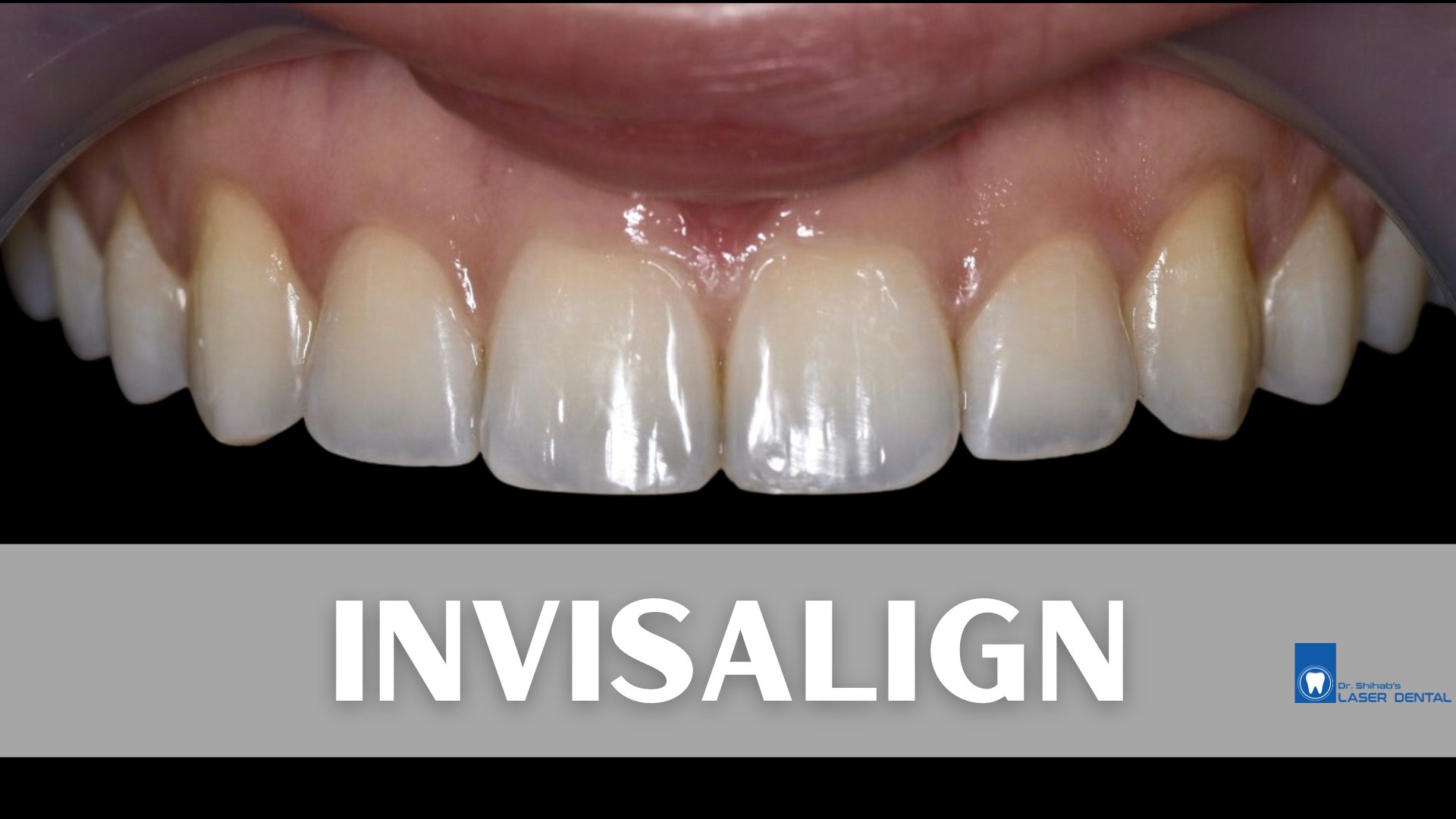 Invisalign clear aligner