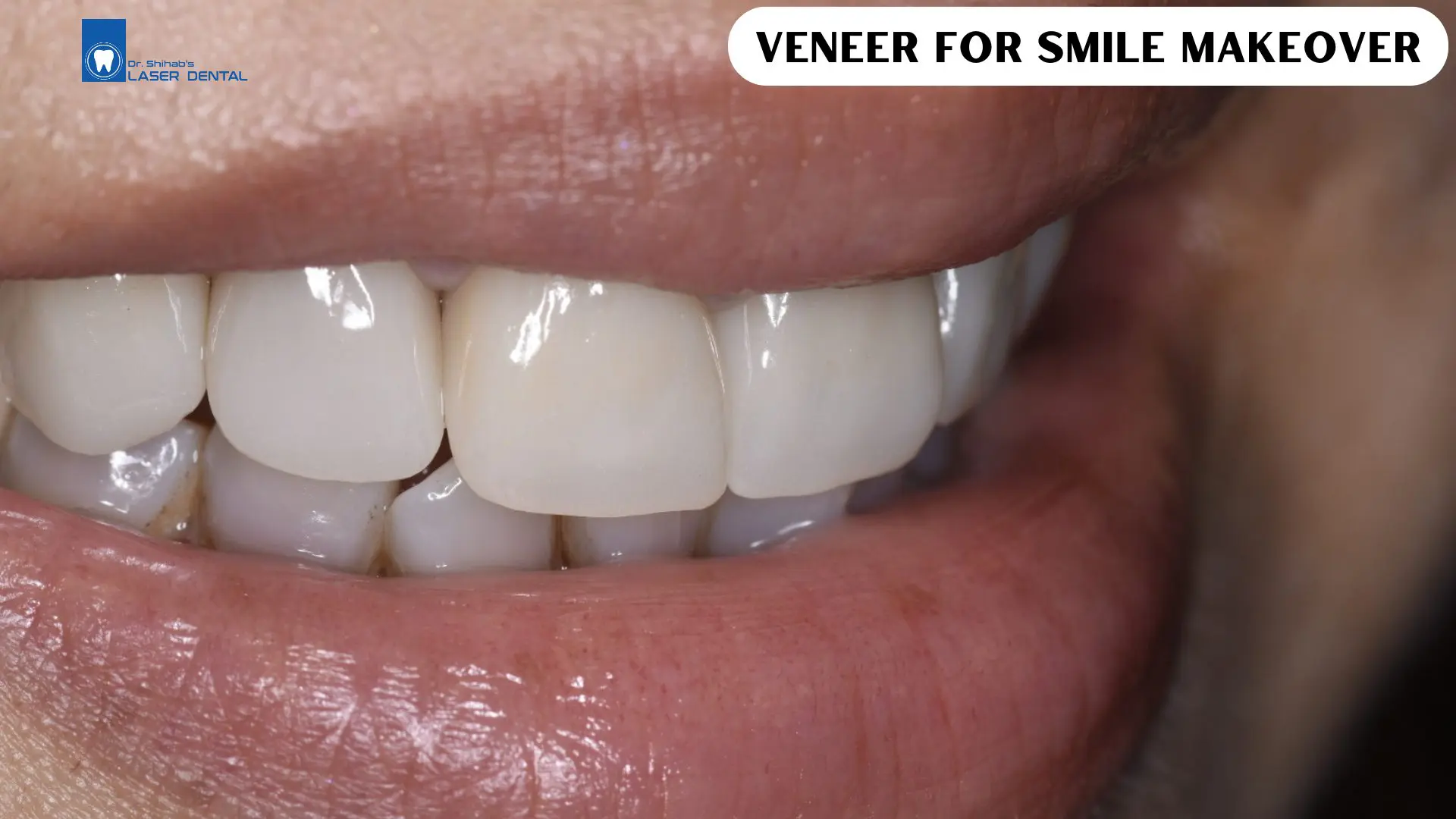 Veneers for smile makeover