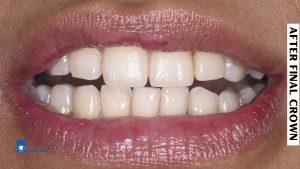 Guided dental implant surgery in Bangladesh